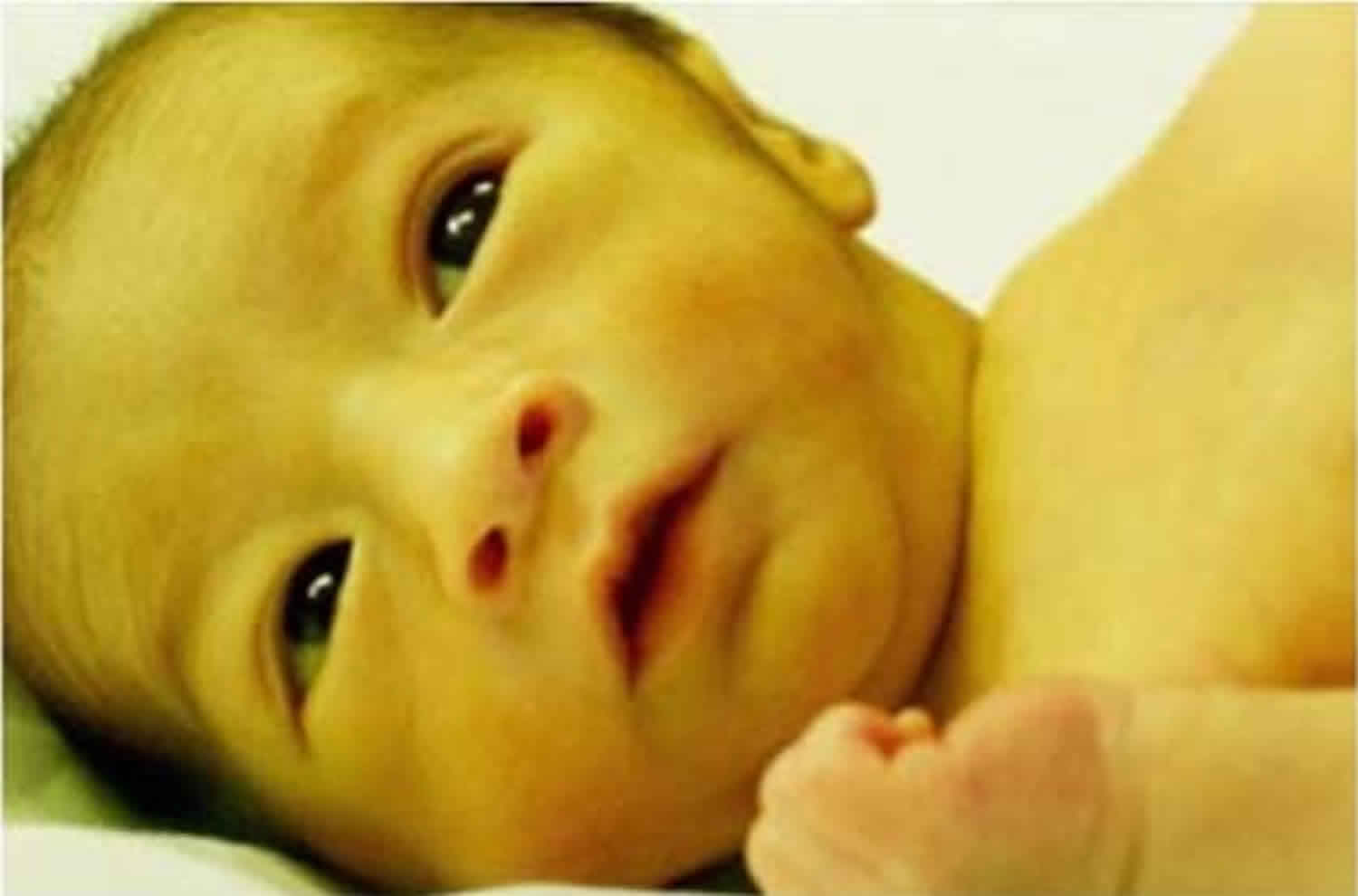 Crigler-Najjar-syndrome