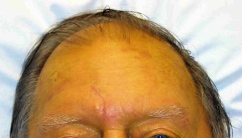 Dubin-Johnson-syndrome