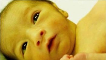 Hyperbilirubinemia in newborn