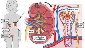 Post-streptococcal-glomerulonephritis