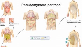 Pseudomyxoma peritonei
