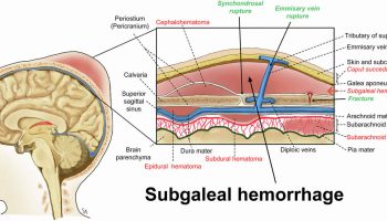 Subgaleal hemorrhage