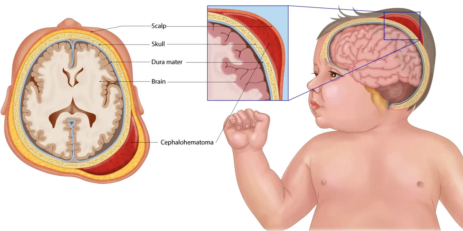 cephalohematoma of newborn