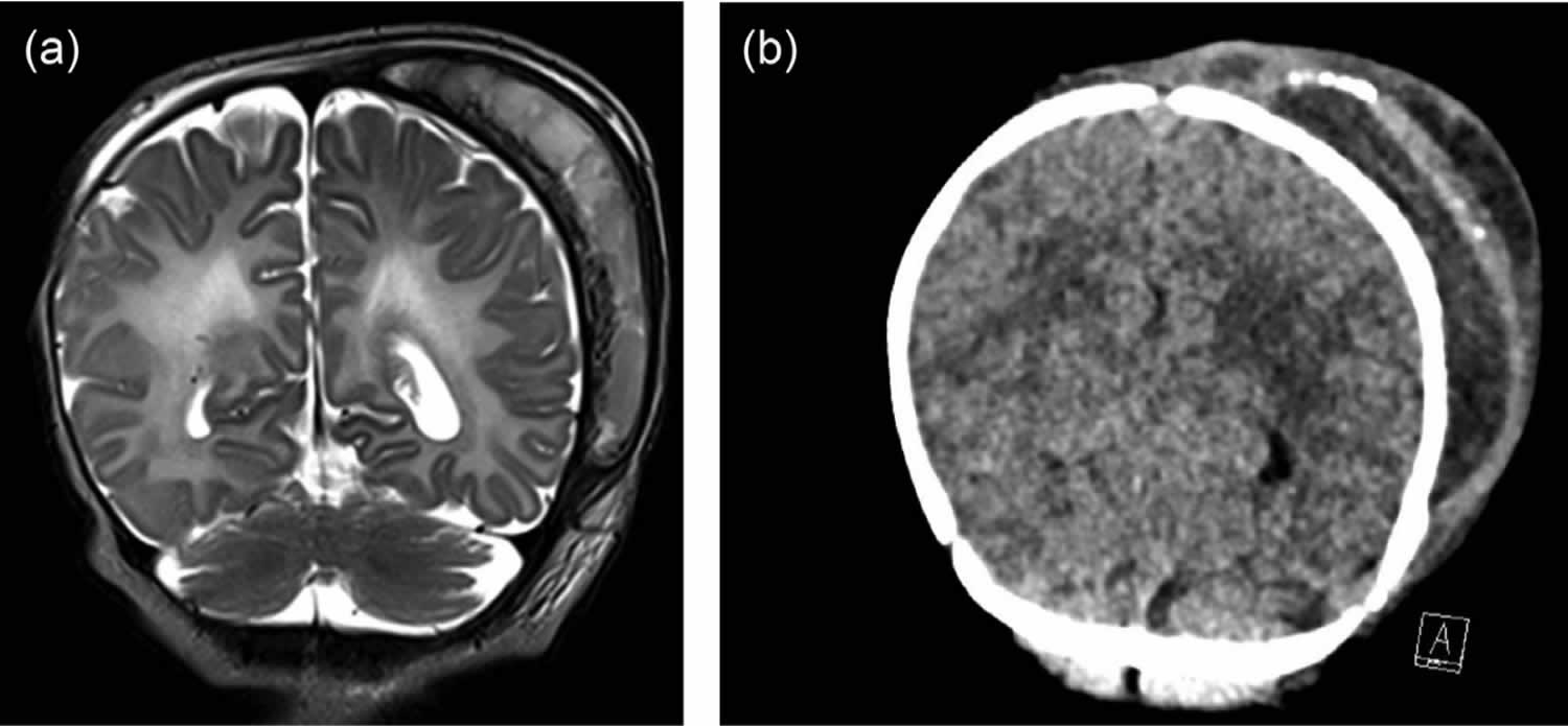 cephalohematoma with abscess formation