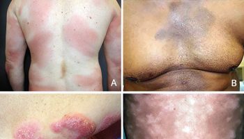 cutaneous T cell lymphoma