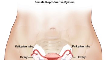 peritoneal carcinomatosis