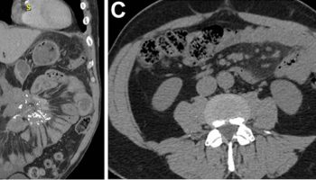 sclerosing mesenteritis CT